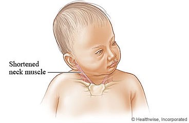 child with torticollis