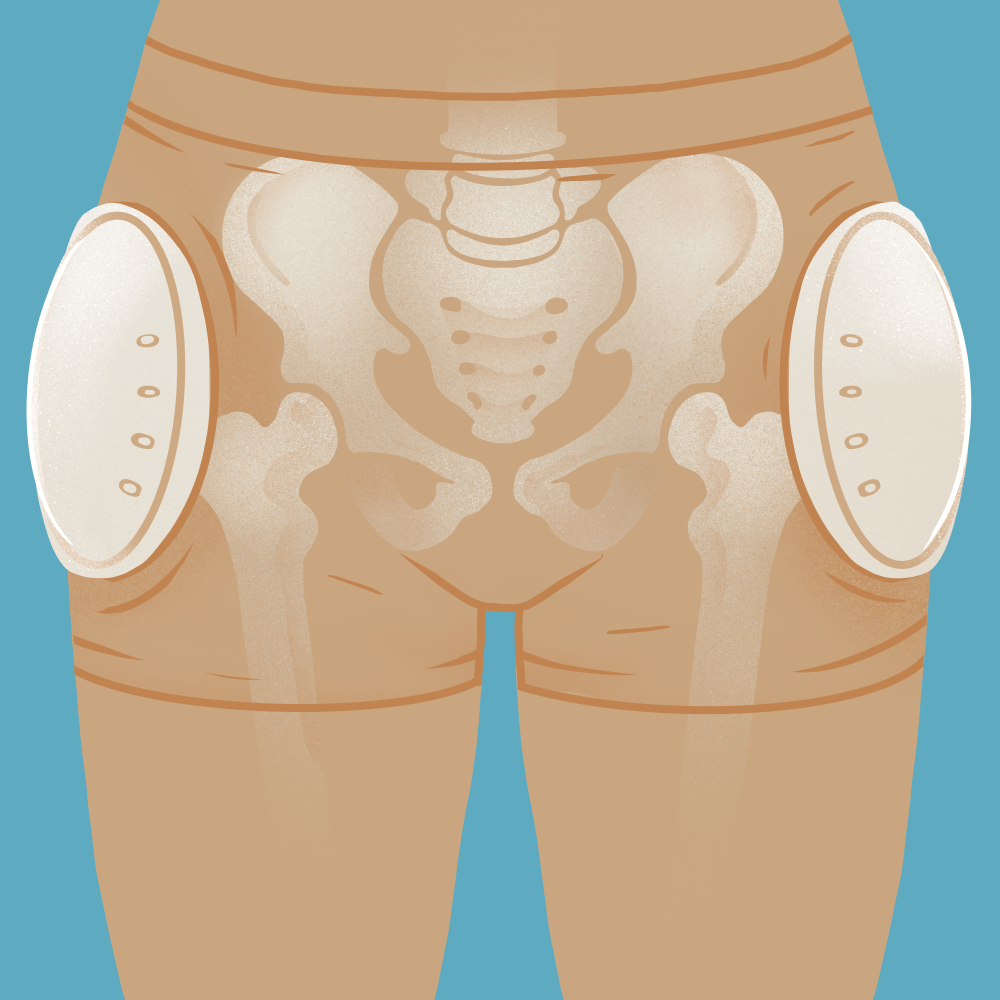 The pelvis of a person wearing underwear-style hip protectors with padding on the hips. The bones in the pelvis area are visible to show what bones the hip protectors cover.