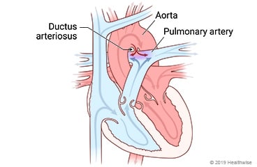 Heart showing patent ductus arteriosus and change in blood flow