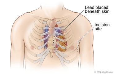 Location in the chest where a subcutaneous ICD is placed under the skin