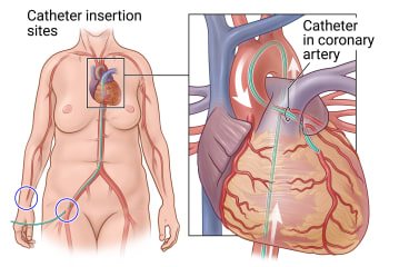 Catheter insertion sites at wrist and groin showing catheter inserted at groin to heart, with close-up of catheter in coronary artery.