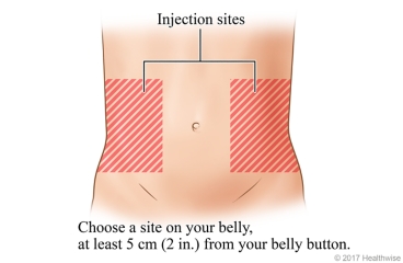 Injection sites, to either side and at least 5 centimetres (2 inches) from belly button.
