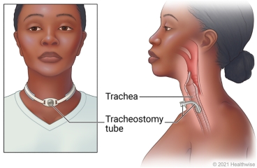 Front view of tracheostomy tube in neck with inside view of tracheostomy tube inserted into trachea.