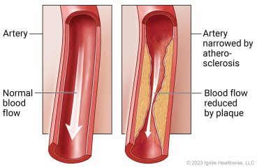Inside view of artery with normal blood flow compared to artery affected by atherosclerosis, with blood flow reduced by plaque.