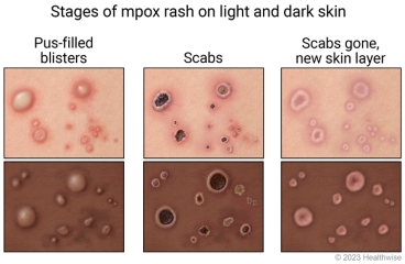 Stages of mpox on light and dark skin, showing pus-filled blisters, then scabs, and then scabs gone with a new skin layer as it heals.