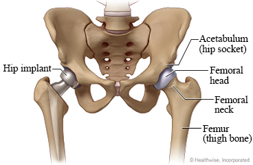Normal hip and partial hip replacement