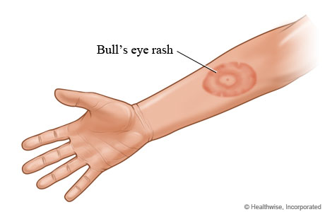 Lyme disease "bull's eye" rash.