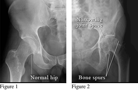 X-ray of osteoarthritis of the hip.