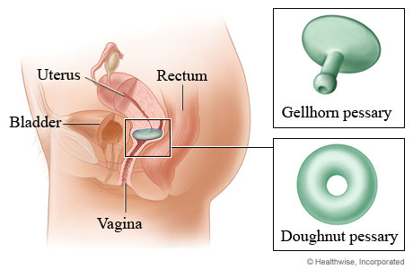 Gellhorn and doughnut pessaries.