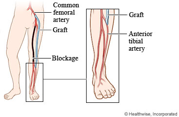 Grafted blood vessel that goes around a blockage