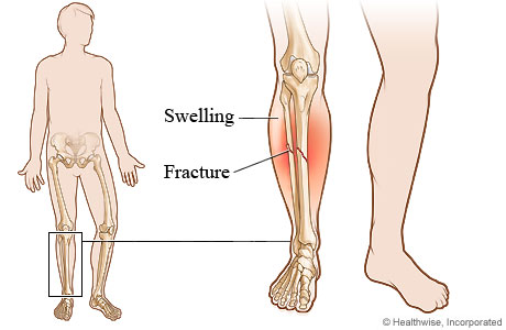 Lower leg fracture.