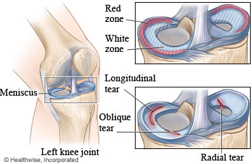 Meniscus and meniscus tear