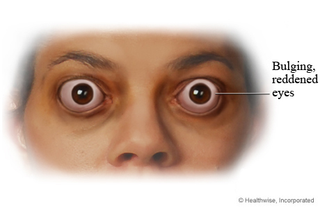 Bulging eyes caused by thyroid disease.