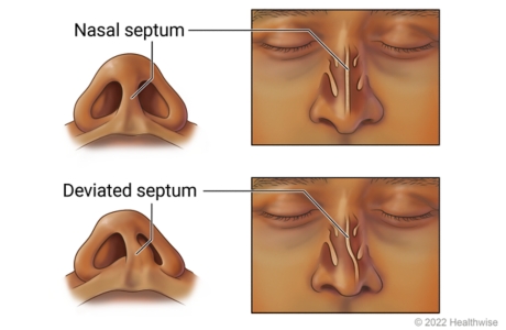 Deviated nasal septum