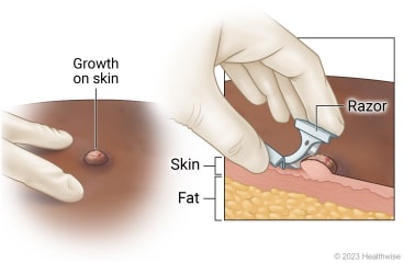 Shave skin biopsy
