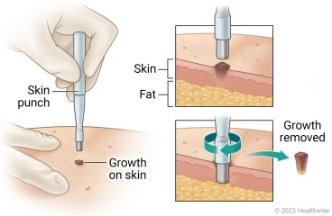 Punch biopsy