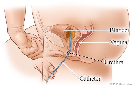 Side view showing catheter inserted through the urethra and into the bladder. Side view showing catheter inserted through the urethra and into the bladder.