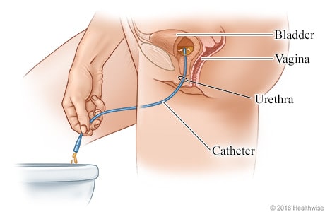 Side view showing urine draining through the catheter, from the bladder into the toilet. Side view showing urine draining through the catheter, from the bladder into the toilet.