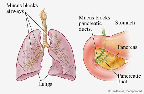 Organs Most Frequently Affected by Cystic Fibrosis