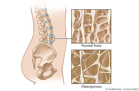Healthy Bone Versus Bone Weakened by Osteoporosis