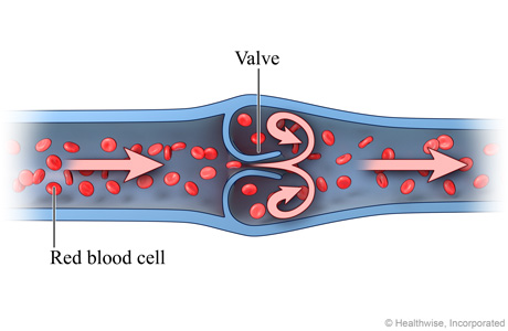 Formation of a blood clot in a vein
