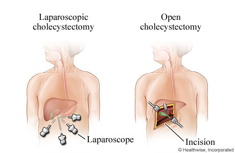 Types of Surgery to Remove the Gallbladder