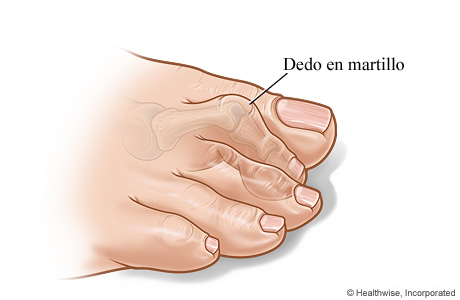 Dedo del pie en martillo Dedo del pie en martillo