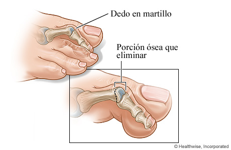 Dedo del pie en martillo y la sección ósea que se va a extraer Dedo del pie en martillo y la sección ósea que se va a extraer