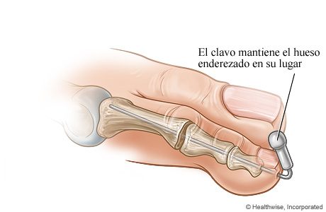 Clavo que sujeta el hueso enderezado en su lugar Clavo que sujeta el hueso enderezado en su lugar