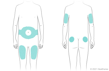 Lugares del cuerpo para administrar inyecciones de insulina