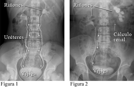 Cálculo renal visto en una pielografía intravenosa (IVP)