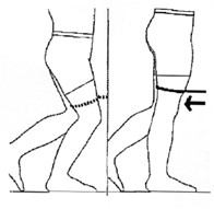 Straightening knee with band