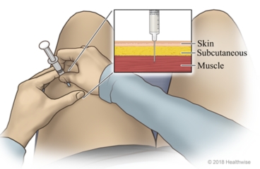 Needle through skin with detail of needle going through subcutaneous tissue to muscle.
