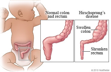 Location of the colon in an infant, with detail of a normal colon and a colon with Hirschsprung disease.