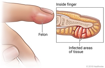 Felon on pad of fingertip, with detail of inside finger showing infected areas of tissue