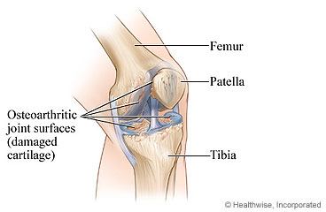Knee joint with osteoarthritis