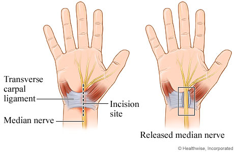 Open carpal tunnel release surgery.