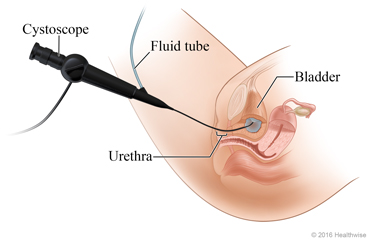 Cystoscope placement through urethra into bladder