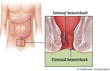 Picture of internal and external hemorrhoids