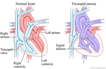 Normal heart and heart without a tricuspid valve, showing smaller right ventricle and change in blood flow
