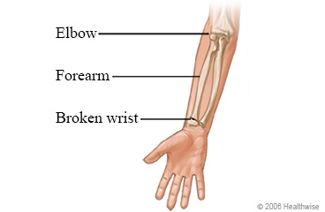 The arm bones and a broken wrist