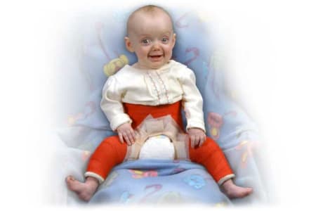 Un niño con yeso en espica sin barra