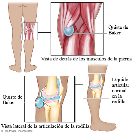 Quiste de Baker