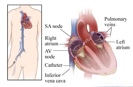 How a catheter is inserted through a vein to the heart.