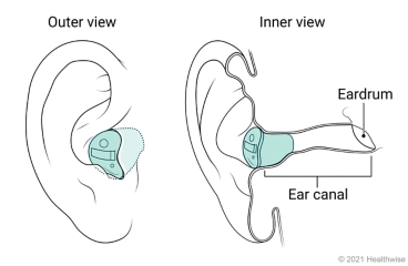 Outer and inner views of in-the-canal hearing aid placed in ear. Outer and inner views of in-the-canal hearing aid placed in ear.