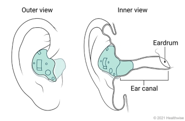 Outside and inside views of an in-the-ear hearing aid placed in ear. Outside and inside views of an in-the-ear hearing aid placed in ear.