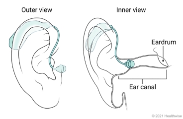 Outer and inner view of a mini BTE hearing aid placed in ear. Outer and inner view of a mini BTE hearing aid placed in ear.
