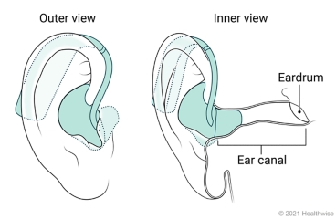 Outer and inner view of behind-the-ear hearing aid placed in ear. Outer and inner view of behind-the-ear hearing aid placed in ear.