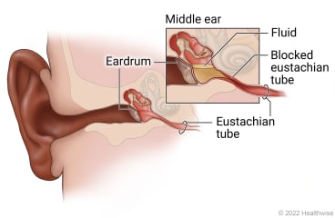 Ear anatomy showing eardrum, middle ear, and eustachian tube, with detail of fluid buildup caused by blocked eustachian tube. Ear anatomy showing eardrum, middle ear, and eustachian tube, with detail of fluid buildup caused by blocked eustachian tube.
