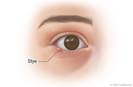 Eye with stye on lower eyelid.